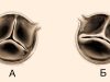 Двустворчатый аортальный клапан – распространенный порок сердца