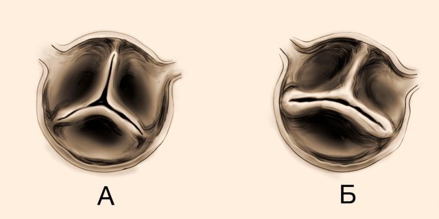 Двустворчатый аортальный клапан – распространенный порок сердца